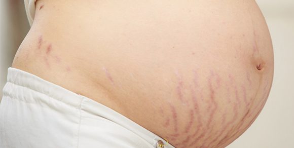 So beugt ihr Schwangerschaftsstreifen vor und entfernt sie So beugt ihr Schwangerschaftsstreifen vor und entfernt sie